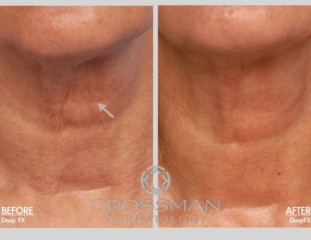 Fractionated Resurfacing Before & After Gallery - Patient 198071 - Image 1