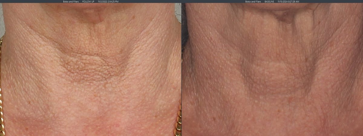 Fractionated Resurfacing Before & After Gallery - Patient 296181 - Image 1