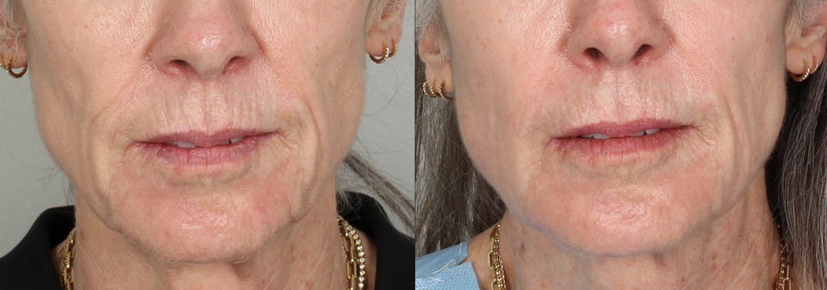 Fat / Micro Fat / Nano Fat Before & After Gallery - Patient 154198 - Image 1