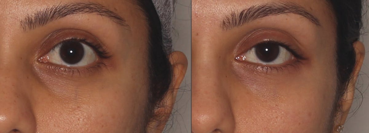 Microneedling Before & After Gallery - Patient 266396 - Image 1