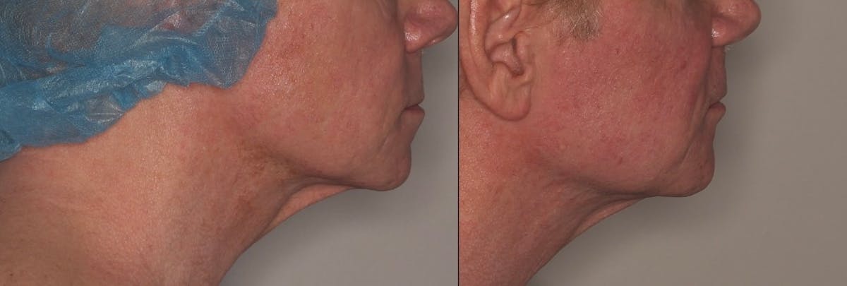 Ellacor Before & After Gallery - Patient 118216 - Image 2