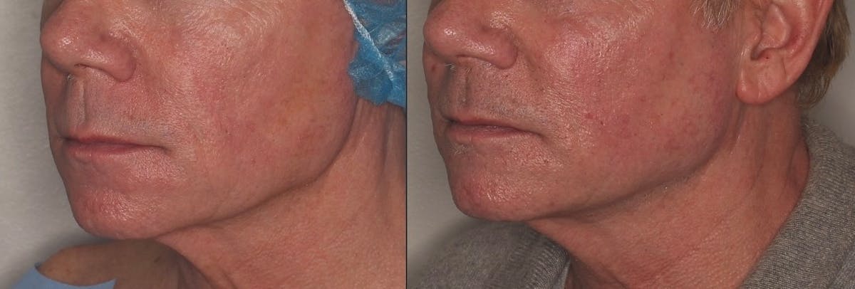 Ellacor Before & After Gallery - Patient 118216 - Image 3