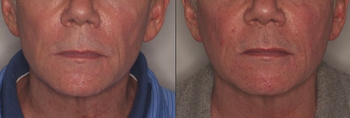 Ellacor Before & After Gallery - Patient 118216 - Image 1