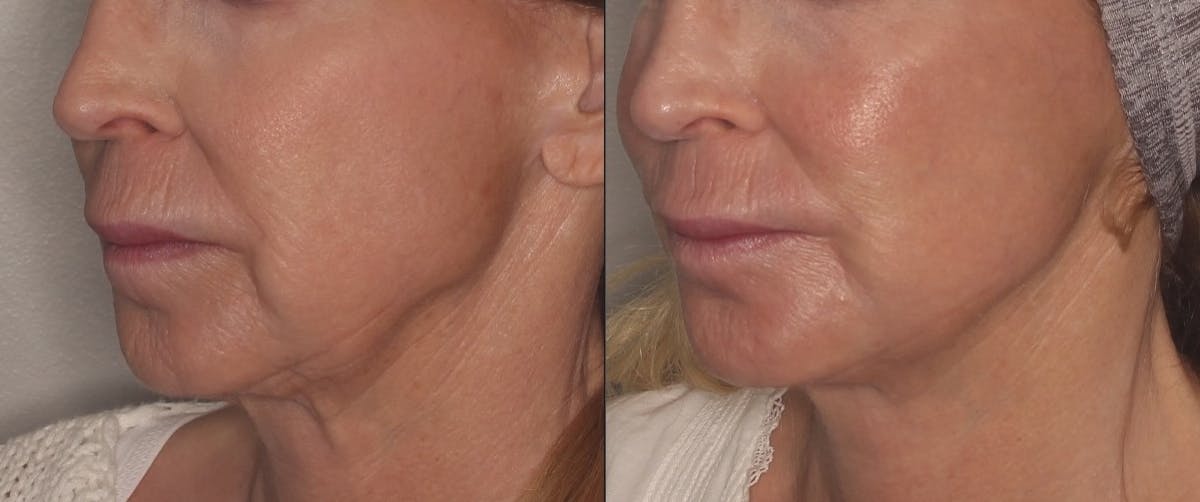 Ellacor Before & After Gallery - Patient 348485 - Image 3