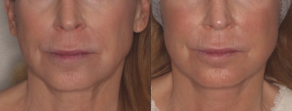 Ellacor Before & After Gallery - Patient 348485 - Image 1