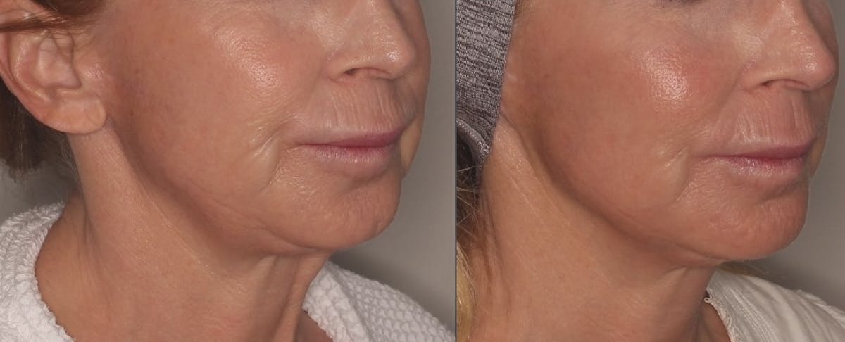 Ellacor Before & After Gallery - Patient 348485 - Image 2