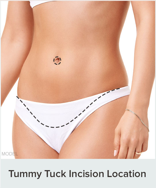 Tummy tuck incision diagram