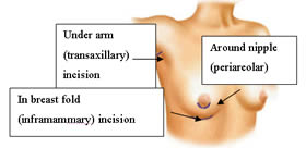diagram of breast incision options