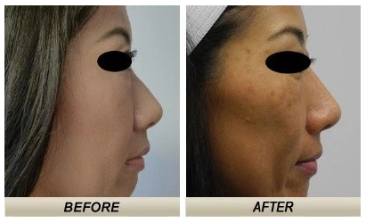 Before-and-after photos of an Asian rhinoplasty case in Honolulu with Dr. Shim Ching.