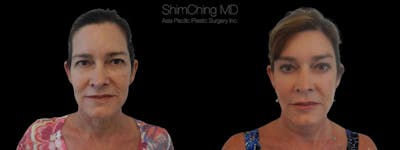 Browlift Before & After Gallery - Patient 38290517 - Image 1