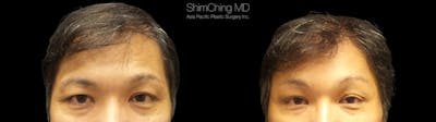 Browlift Before & After Gallery - Patient 38290518 - Image 1