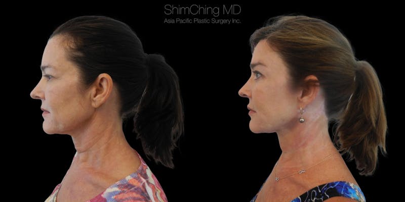 Before and after Facelift surgery in Honolulu with Dr. Shim Ching