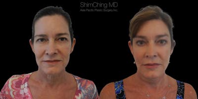 Facelift Before & After Gallery - Patient 38290564 - Image 1