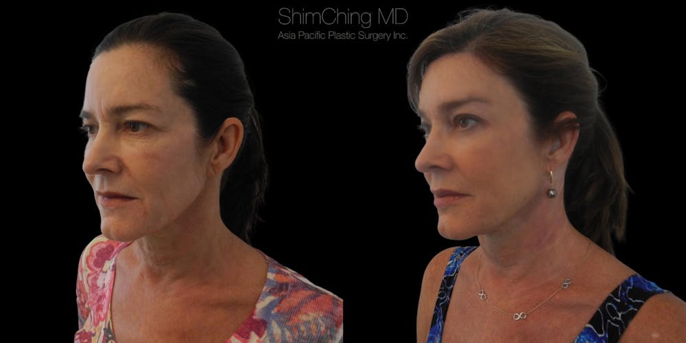 Facelift Before & After Gallery - Patient 38290564 - Image 3