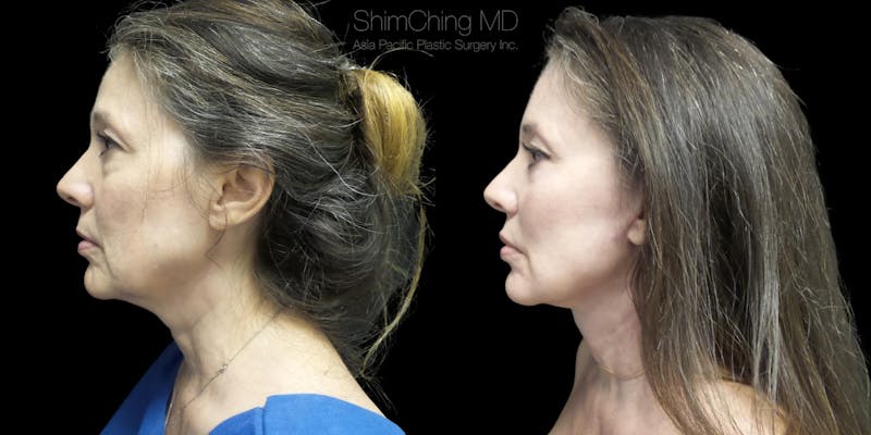 Before and after Facelift surgery in Honolulu Hawaii with Dr. Shim Ching