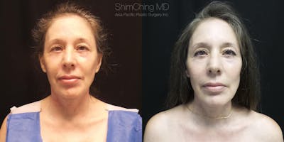 Facelift Before & After Gallery - Patient 38290567 - Image 1