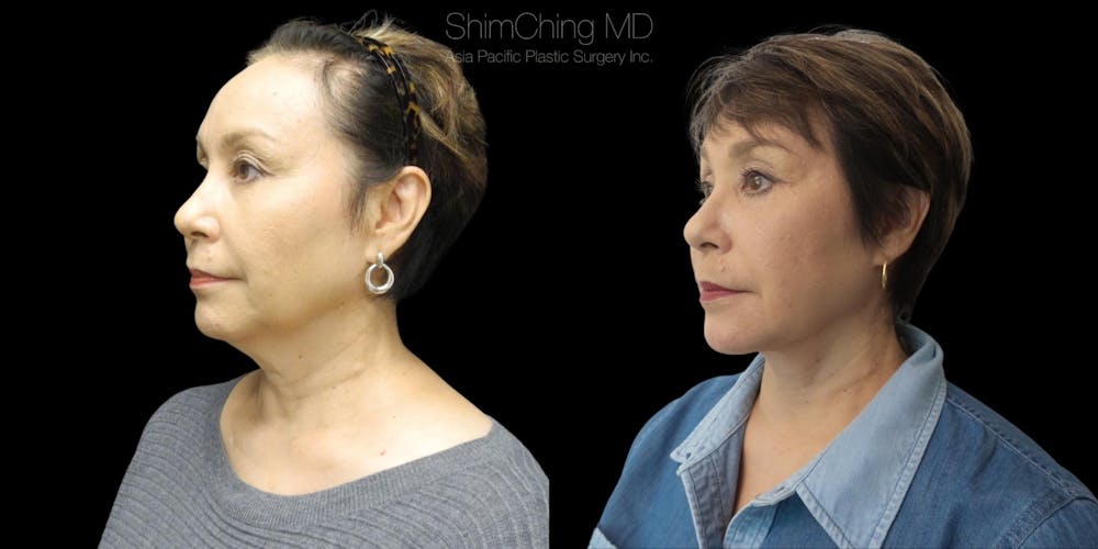 Facelift Before & After Gallery - Patient 38290570 - Image 1