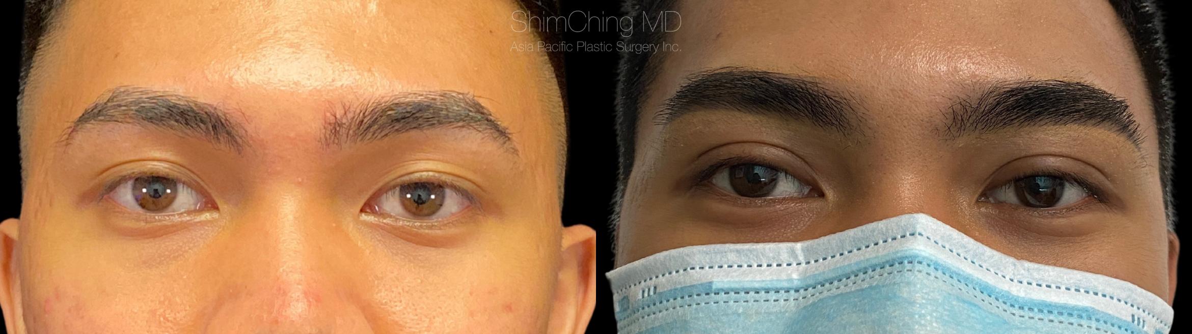 Eyelid shop surgery hawaii