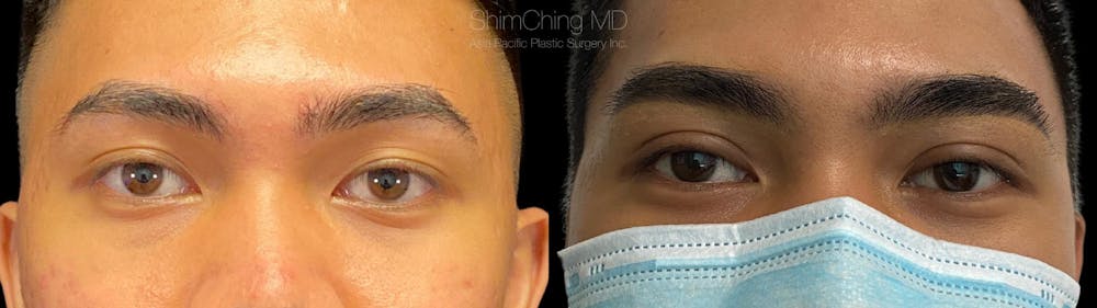 Eyelid Surgery Before & After Gallery - Patient 38290604 - Image 1