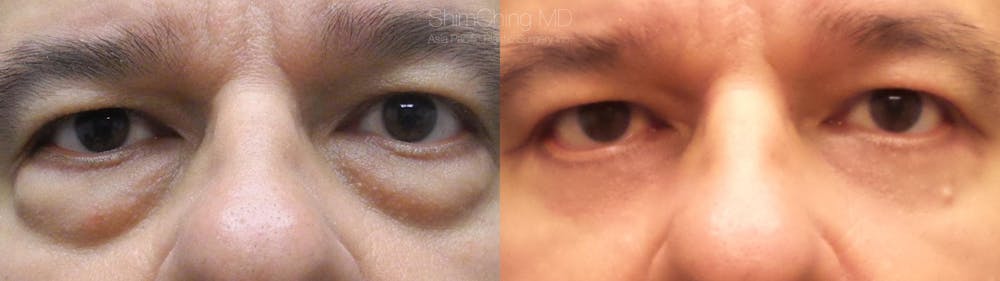 Eyelid Surgery Before & After Gallery - Patient 38290606 - Image 1