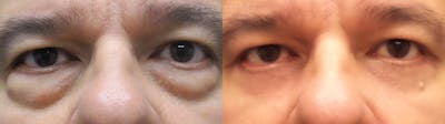 Eyelid Surgery Before & After Gallery - Patient 38290606 - Image 1