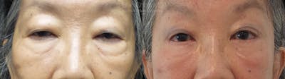Eyelid Surgery Before & After Gallery - Patient 38290610 - Image 1