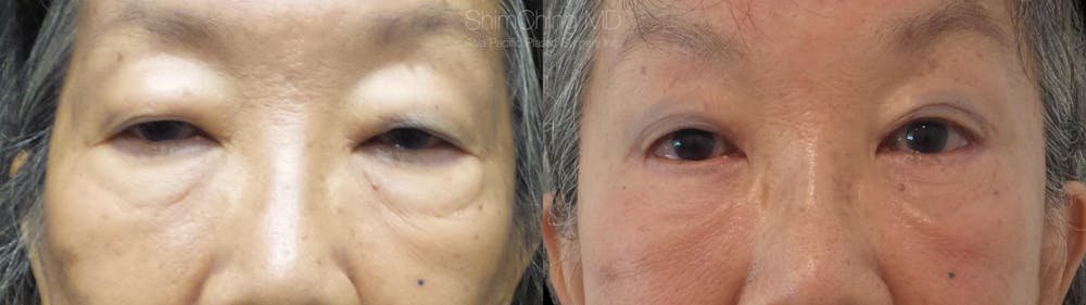 Eyelid Surgery Gallery - Patient 38290610 - Image 1