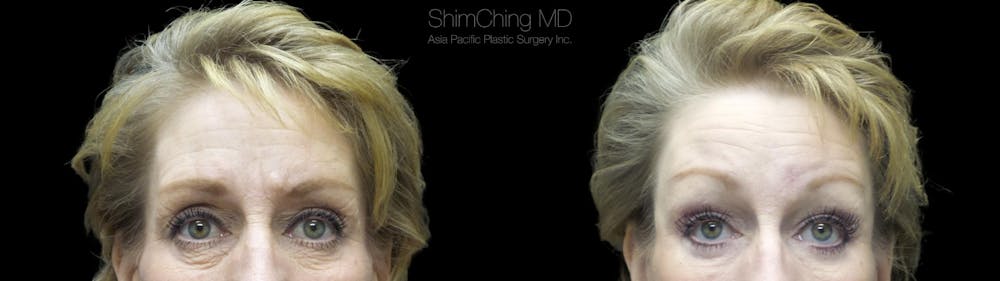 Eyelid Surgery Before & After Gallery - Patient 38290613 - Image 1