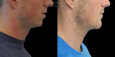 Chin Before & After Gallery - Patient 38290616 - Image 1