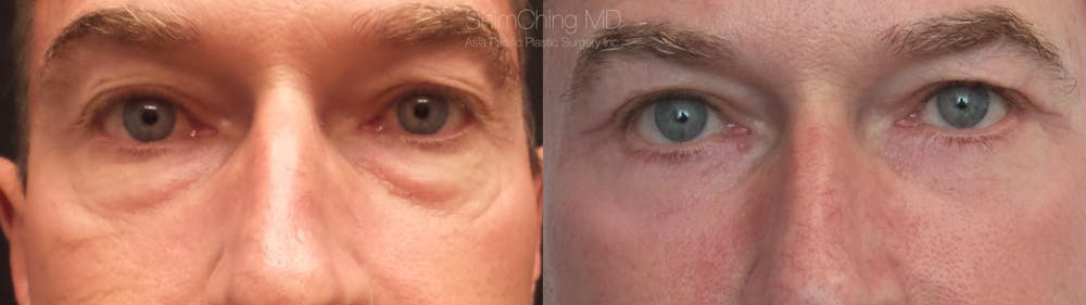 Eyelid Surgery Before & After Gallery - Patient 38290615 - Image 1