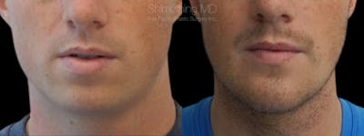 Chin Before & After Gallery - Patient 38290616 - Image 2