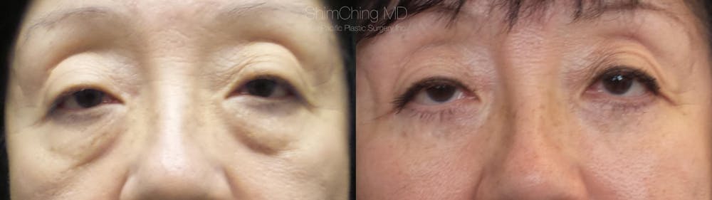 Eyelid Surgery Before & After Gallery - Patient 38290618 - Image 1