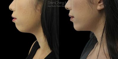 Chin Before & After Gallery - Patient 38290620 - Image 1