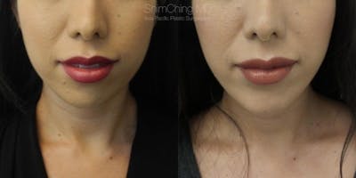 Chin Before & After Gallery - Patient 38290620 - Image 2