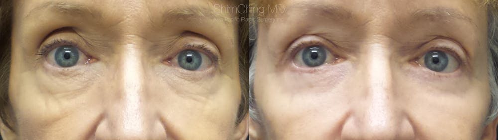 Eyelid Surgery Before & After Gallery - Patient 38290621 - Image 1