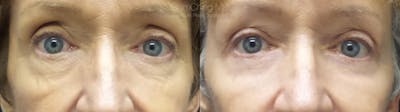 Eyelid Surgery Gallery - Patient 38290621 - Image 1