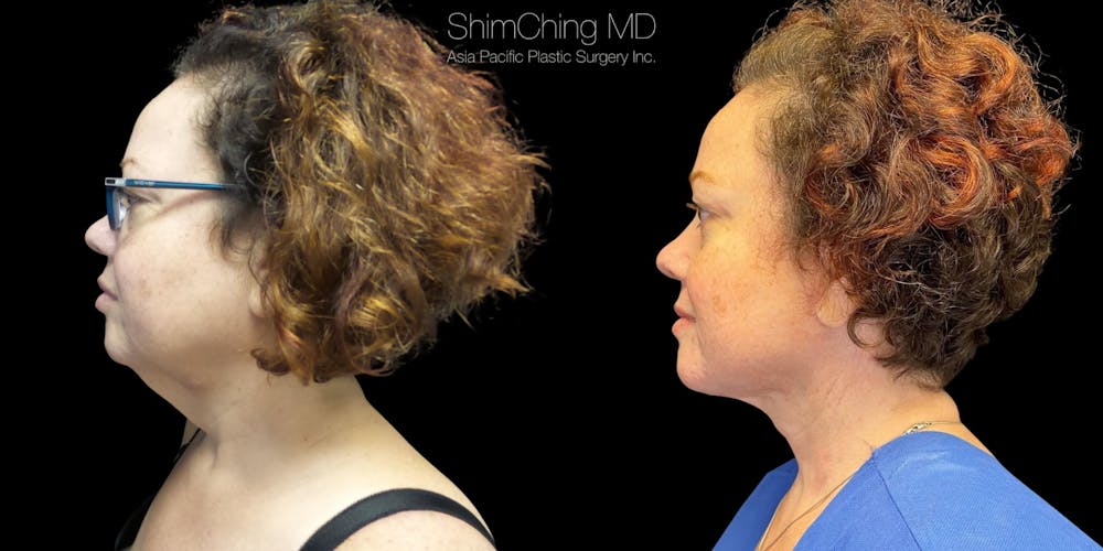 Necklift Before & After Gallery - Patient 38290623 - Image 1