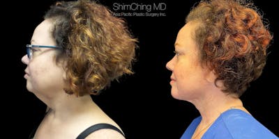 Necklift Before & After Gallery - Patient 38290623 - Image 1