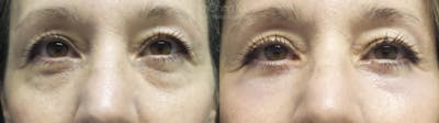 Eyelid Surgery Before & After Gallery - Patient 38290624 - Image 1