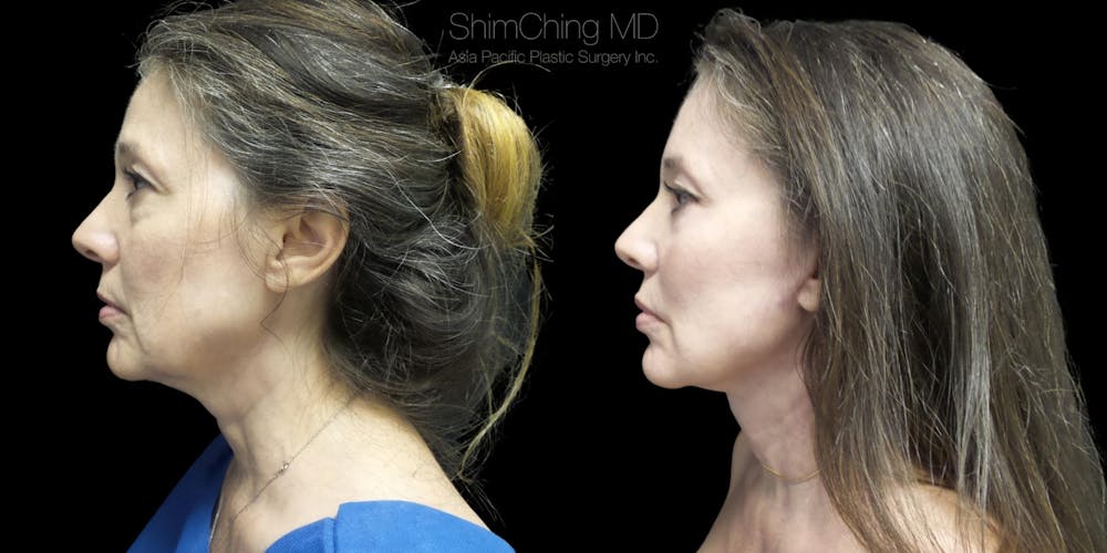 Necklift Before & After Gallery - Patient 38290625 - Image 1