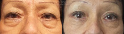 Eyelid Surgery Before & After Gallery - Patient 38290626 - Image 1