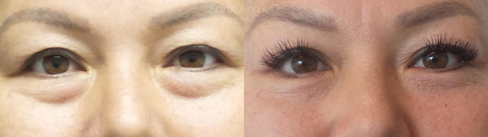 Eyelid Surgery Before & After Gallery - Patient 38290628 - Image 1