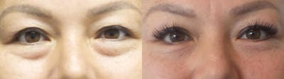 Eyelid Surgery Gallery - Patient 38290628 - Image 1