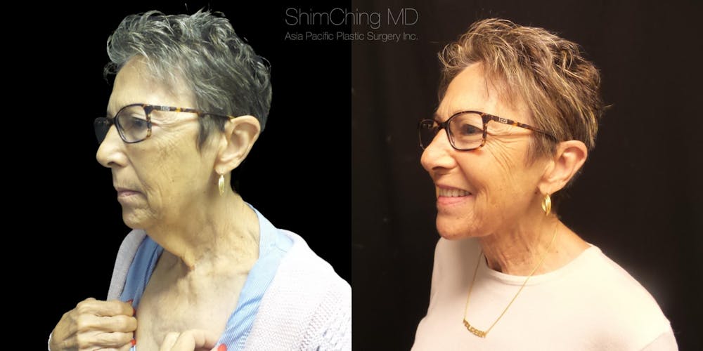 Necklift Before & After Gallery - Patient 38290630 - Image 2
