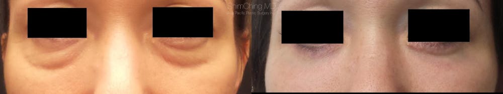 Eyelid Surgery Before & After Gallery - Patient 38290629 - Image 1