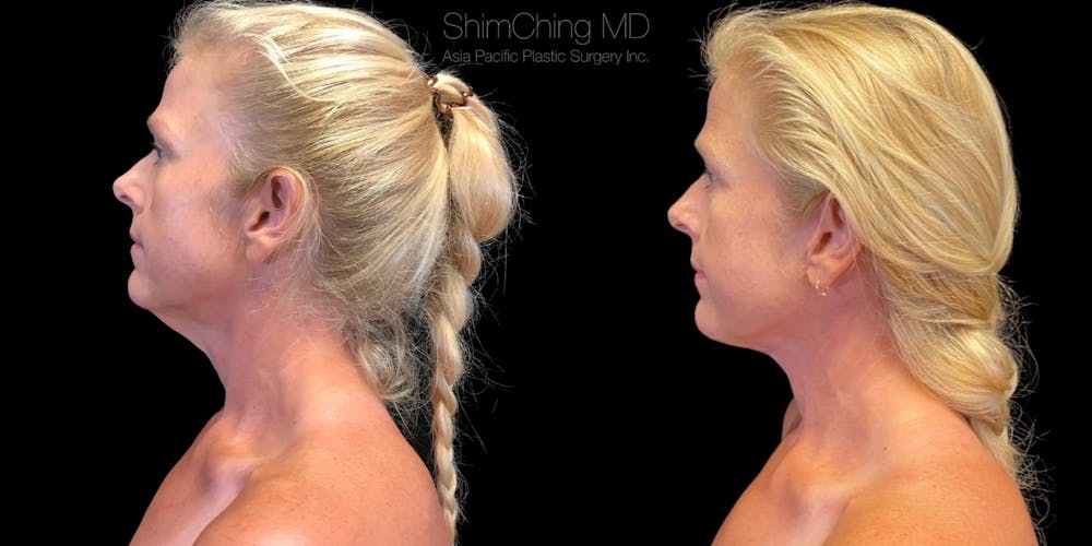 Necklift Before & After Gallery - Patient 38290634 - Image 1