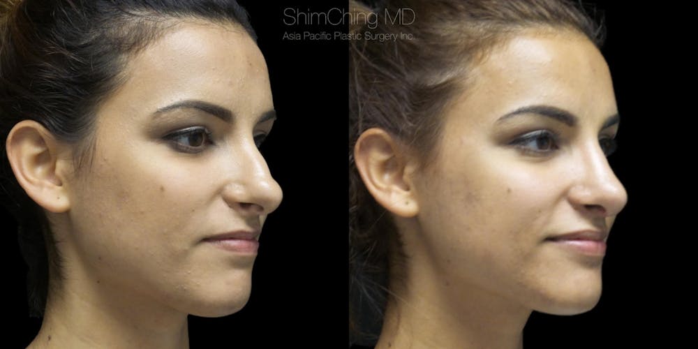 Rhinoplasty Before & After Gallery - Patient 38290640 - Image 1