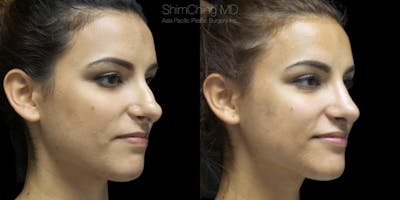 Rhinoplasty Before & After Gallery - Patient 38290640 - Image 1