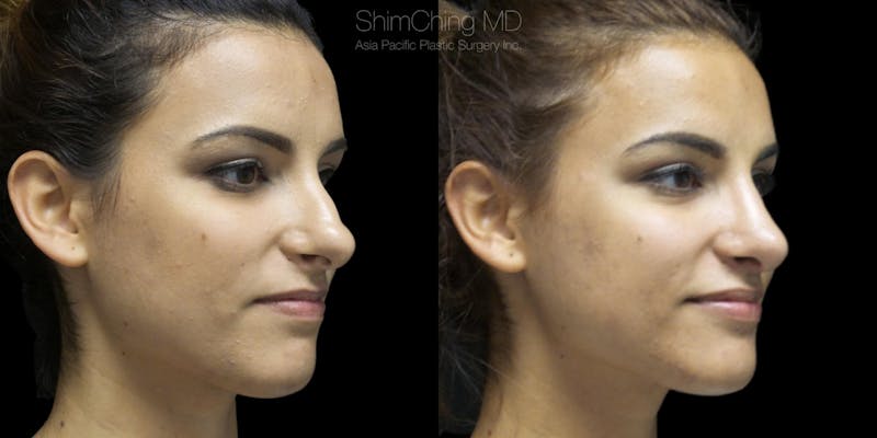 Before and after Rhinoplasty in Honolulu, Hawaii with Dr. Shim Ching