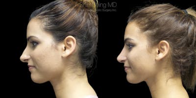 Rhinoplasty Before & After Gallery - Patient 38290640 - Image 2